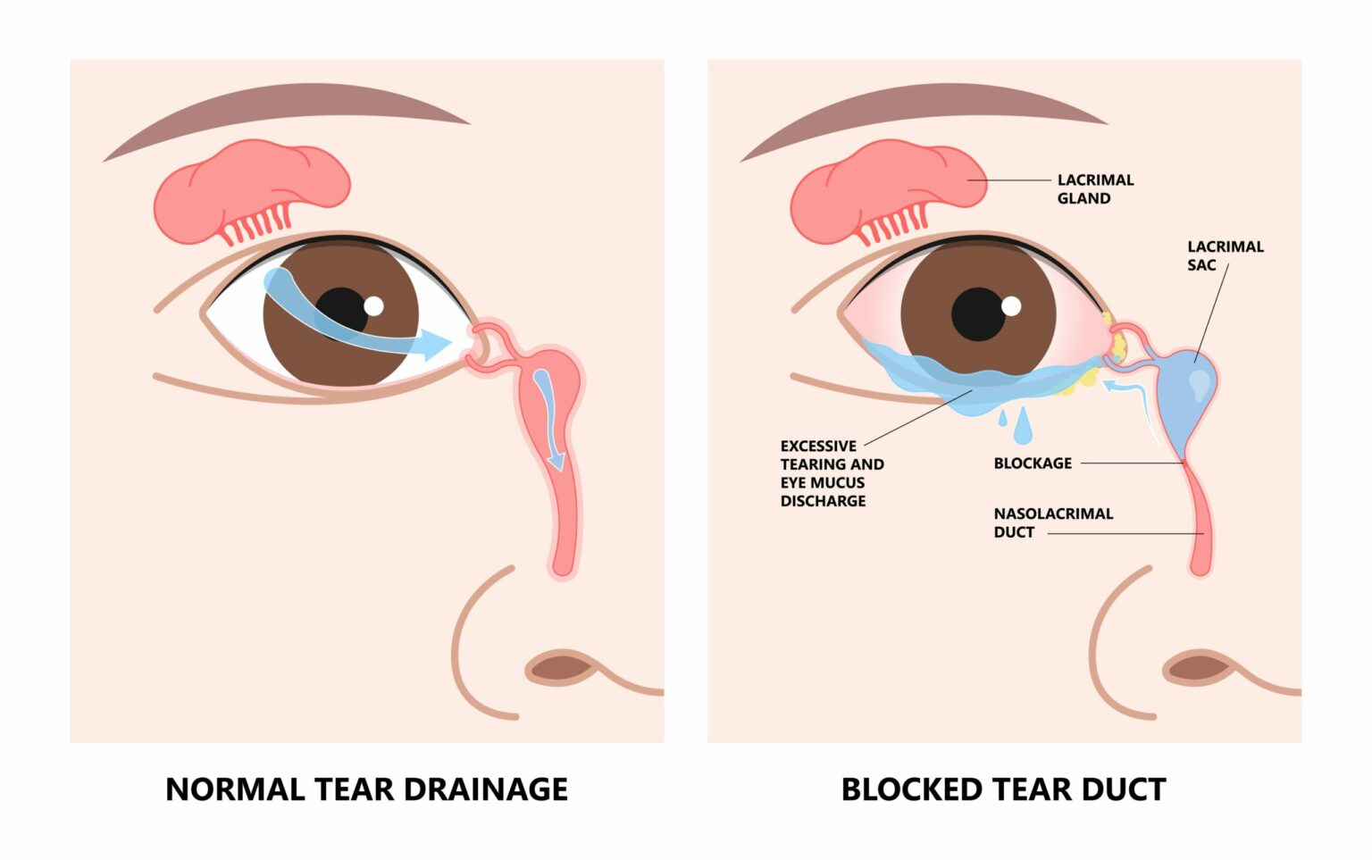 Congenital Nasolacrimal Duct Obstruction Causes And Treatment First Congenital Nasolacrimal Duct Obstruction Causes And Treatment First