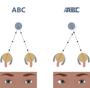 Illustration wie Doppelbilder entstehen, wenn beide Augen nicht auf den selben Punkt schauen.